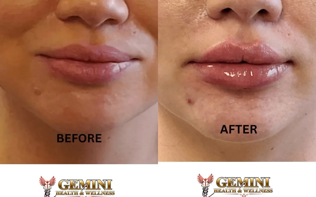 Before and after: dermal filler lip enhancement