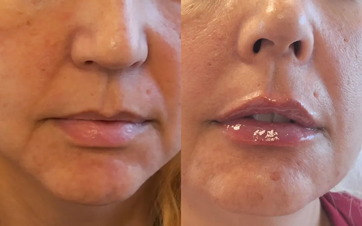Before and after: dermal filler lips and chin refinement
