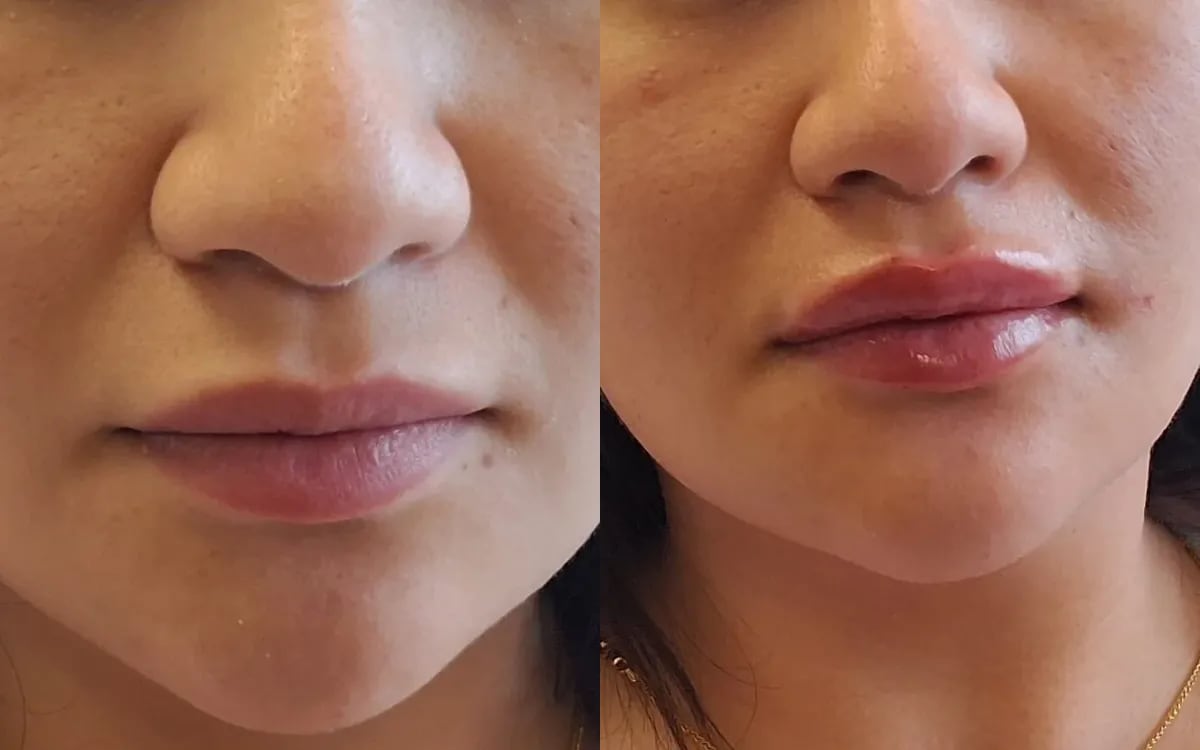 Before and after: dermal filler lip enhancement