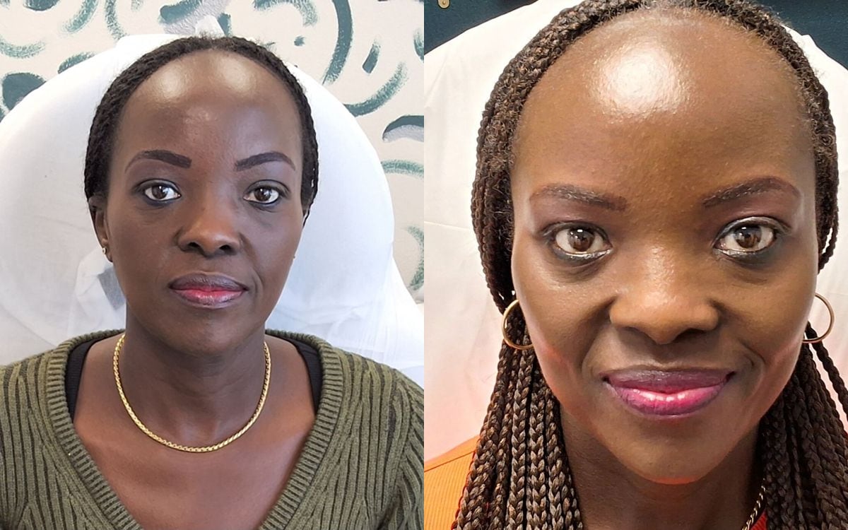 Before and after: dermal filler full face refresh
