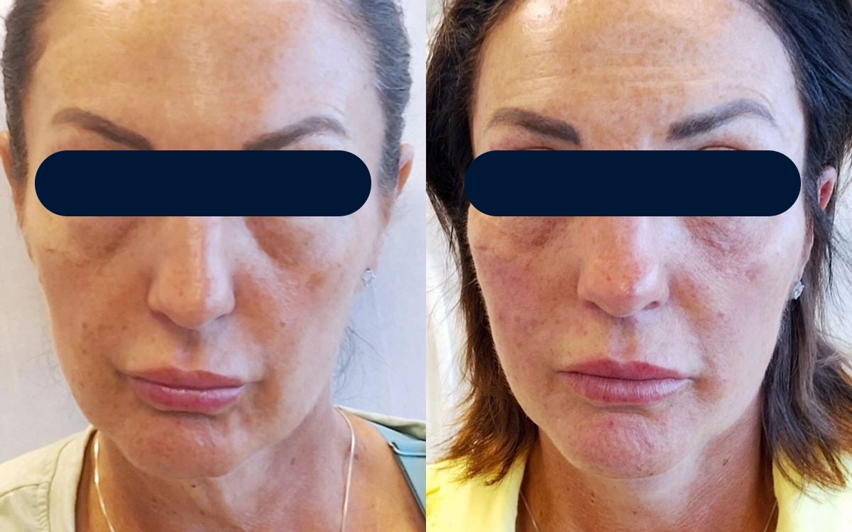 Before and after: dermal filler midface and under-eye treatment