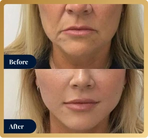 Before and after dermal filler treatment