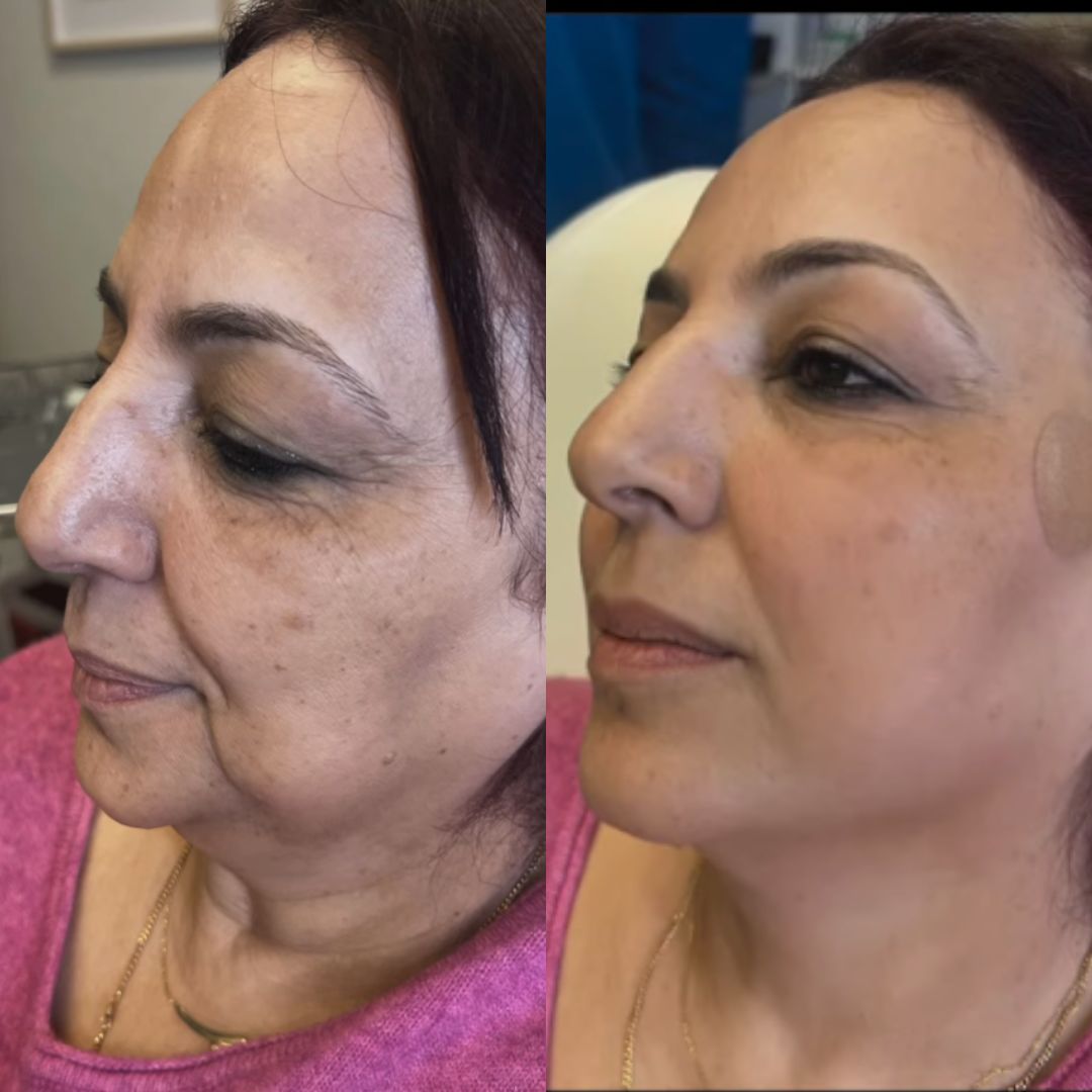 Before and after PDO thread lift, side profile — lifted jawline and softer jowls