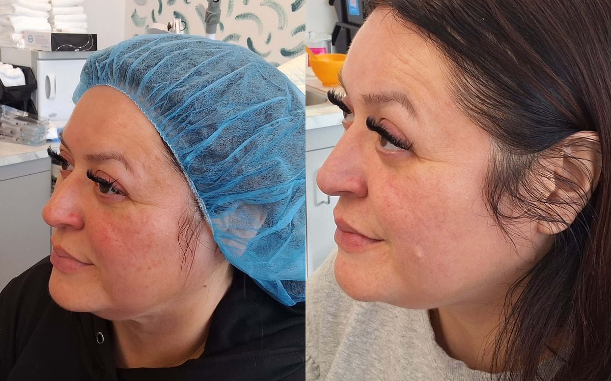 Before and after: PDO Thread Lift · Cheeks & Jawline