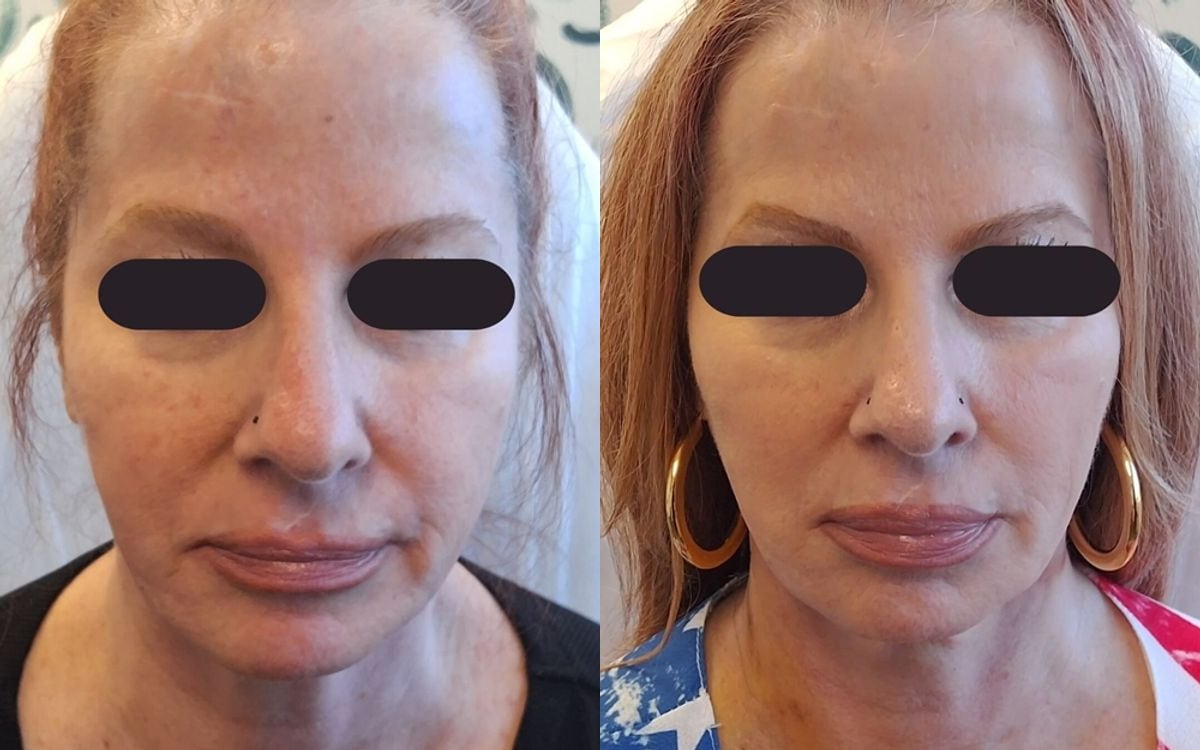 Before and after: PDO Thread Lift · Brow & Lower Face