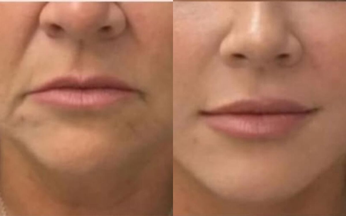 Before and after: PDO Thread Lift · Lower Face