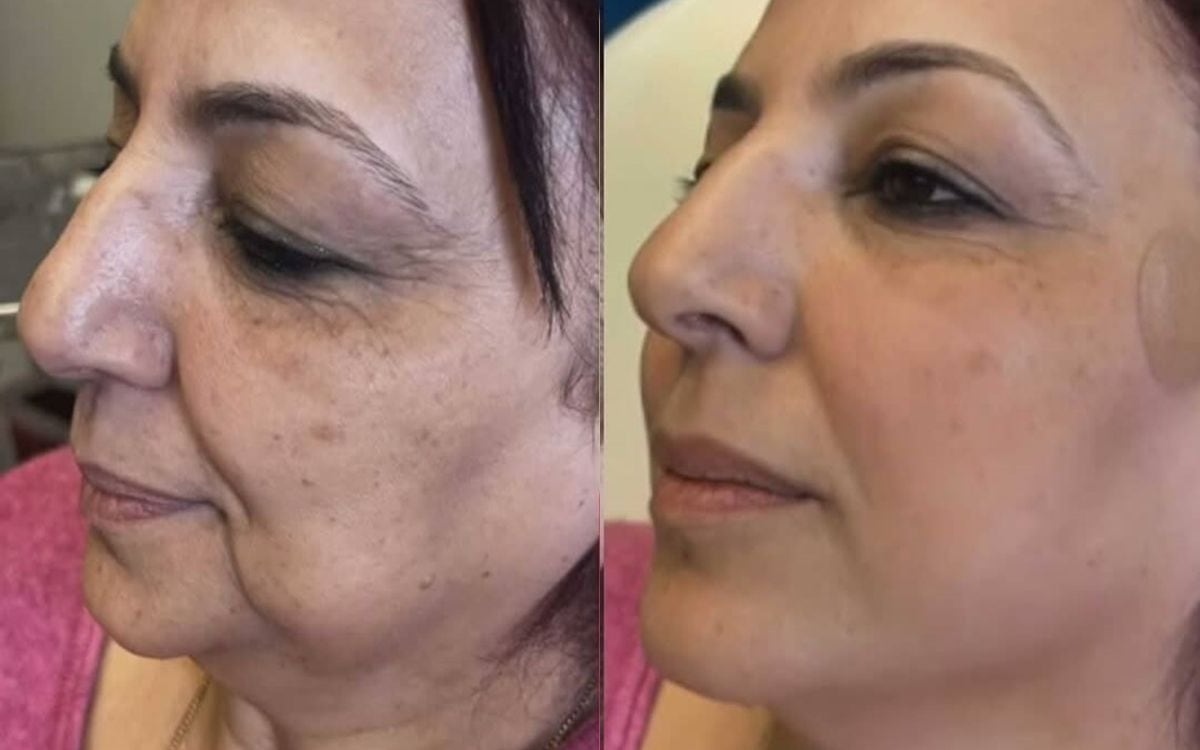 Before and after: PDO Thread Lift · Cheek & Jawline