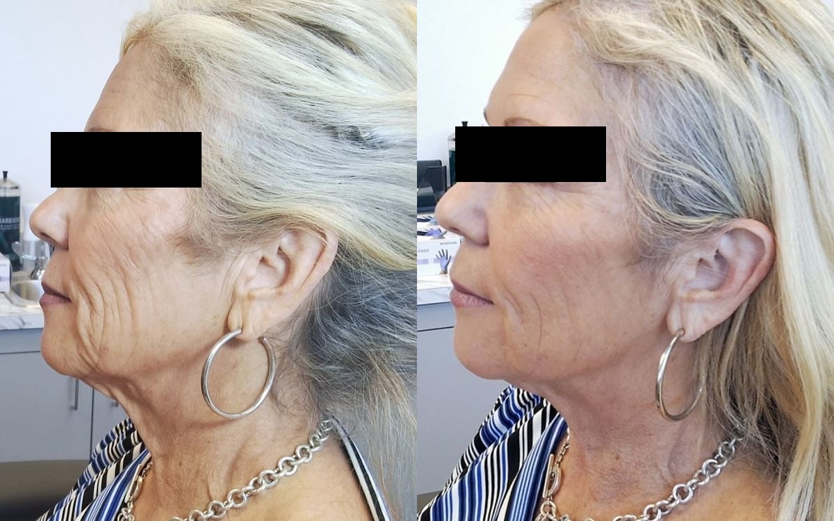 Before and after: PDO Thread Lift · Neck & Jawline