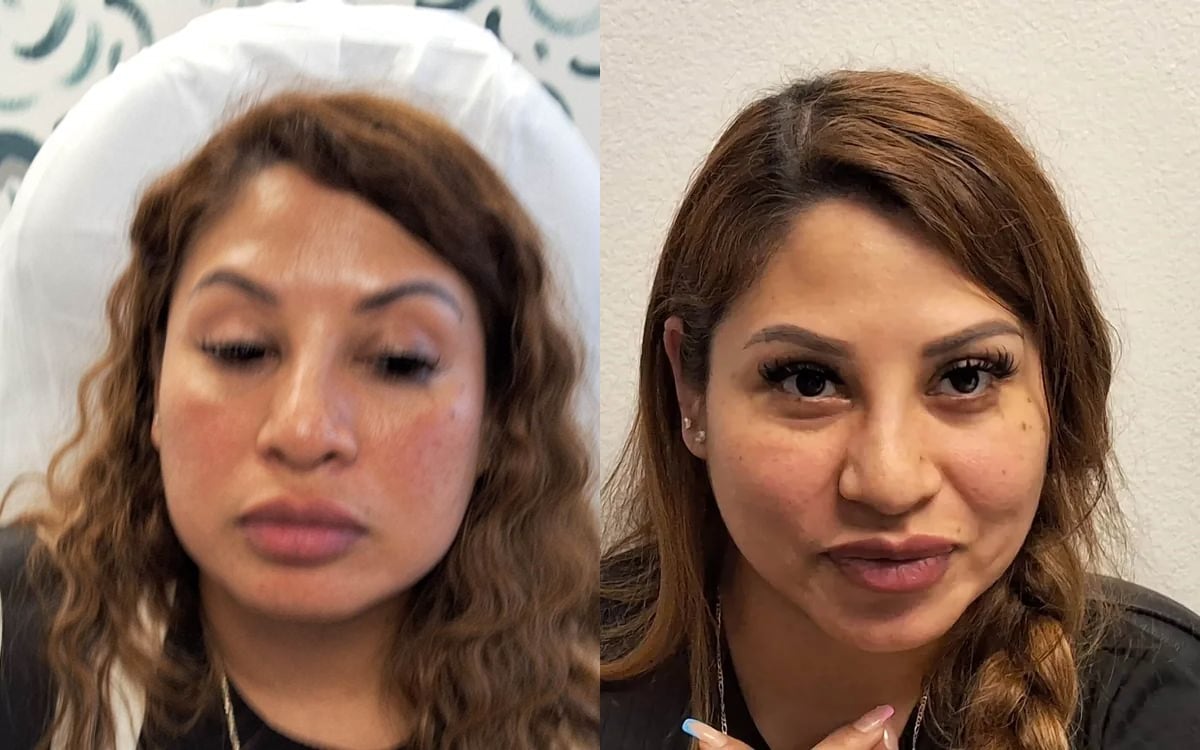 Before and after: PDO Thread Lift · Cheeks & Contour