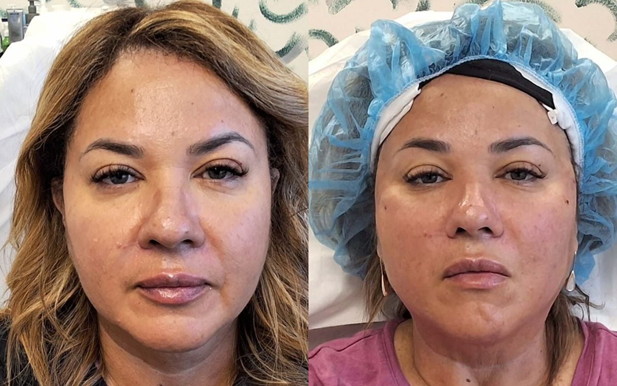 Before and after: PDO Thread Lift · Midface & Cheeks