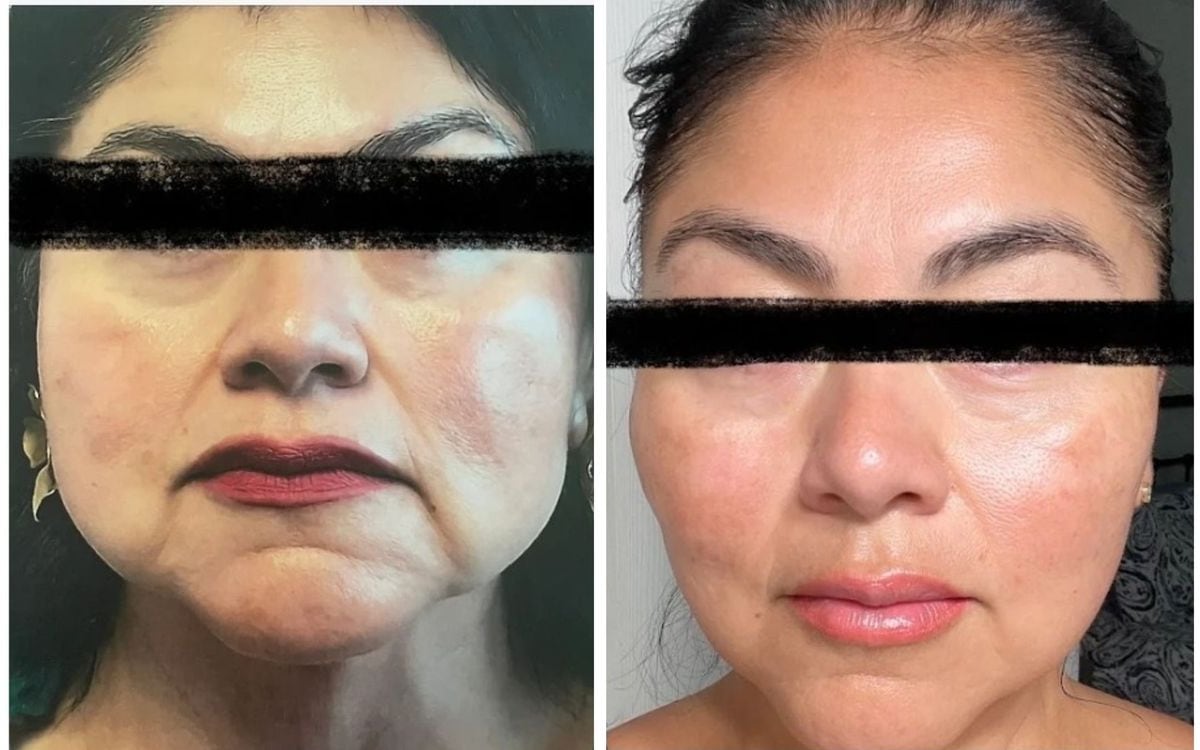 Before and after: PDO Thread Lift · Lower Face & Jowls