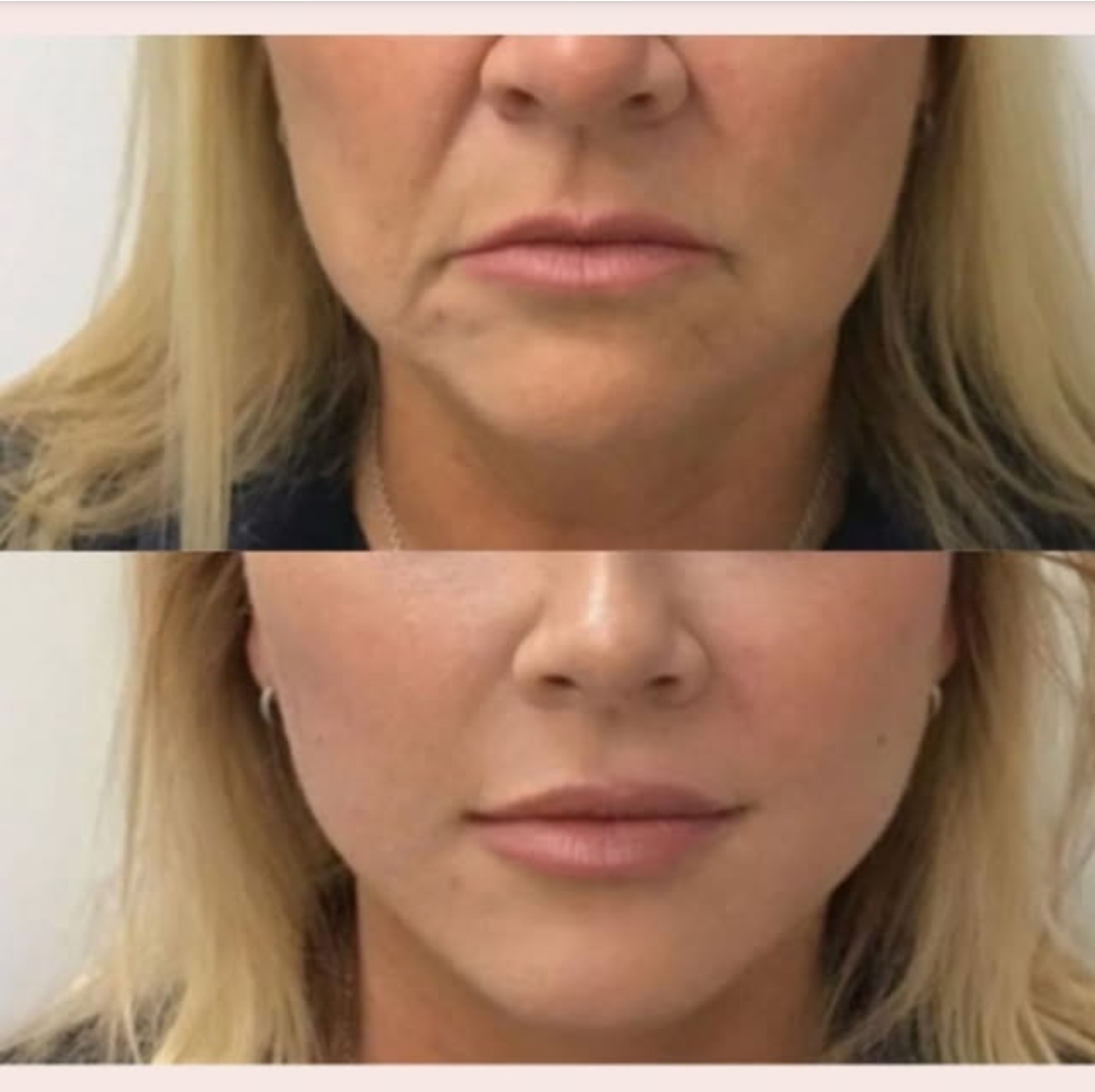 Before and after PDO thread lift, front view — tightened lower face