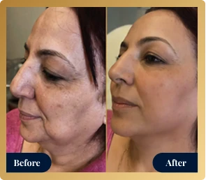 Before and after: PDO thread lift