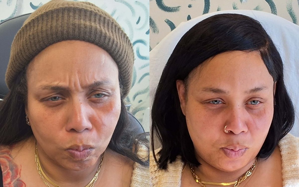 Before and after: wrinkle relaxer treatment softening frown lines
